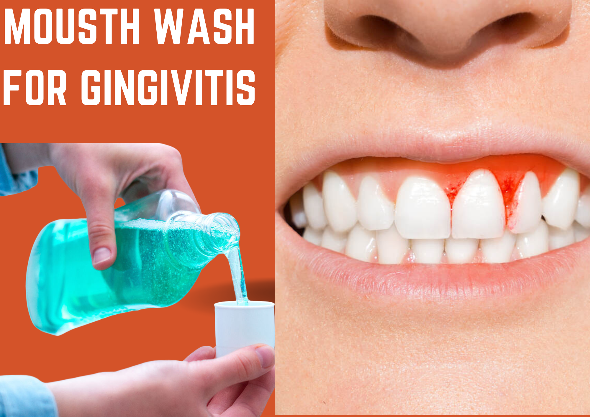 Fight Back Against Gingivitis: The Ultimate US Mouthwash Guide