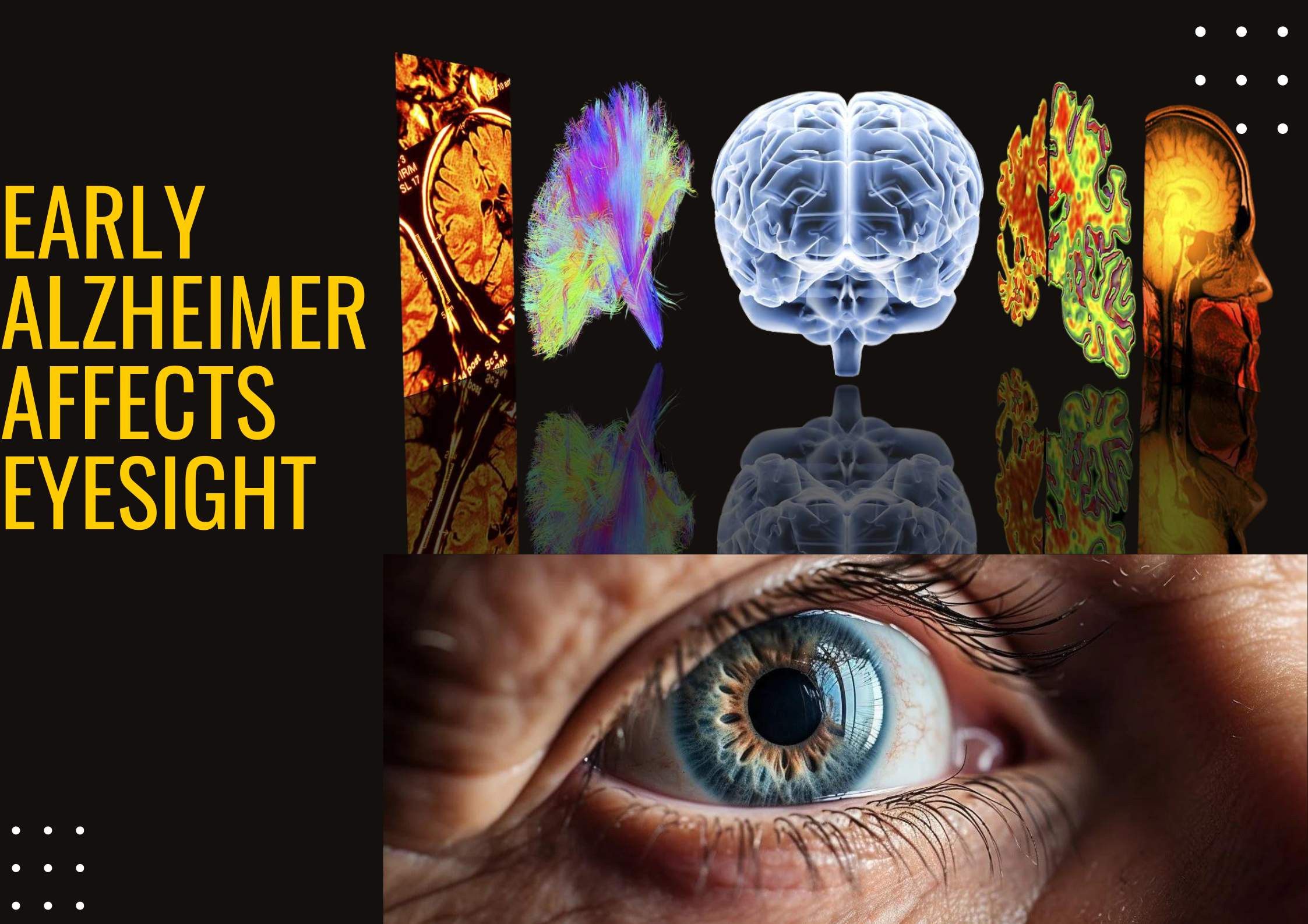 “Visions of the Mind: Exploring How Early Alzheimer’s Affects Eyesight”