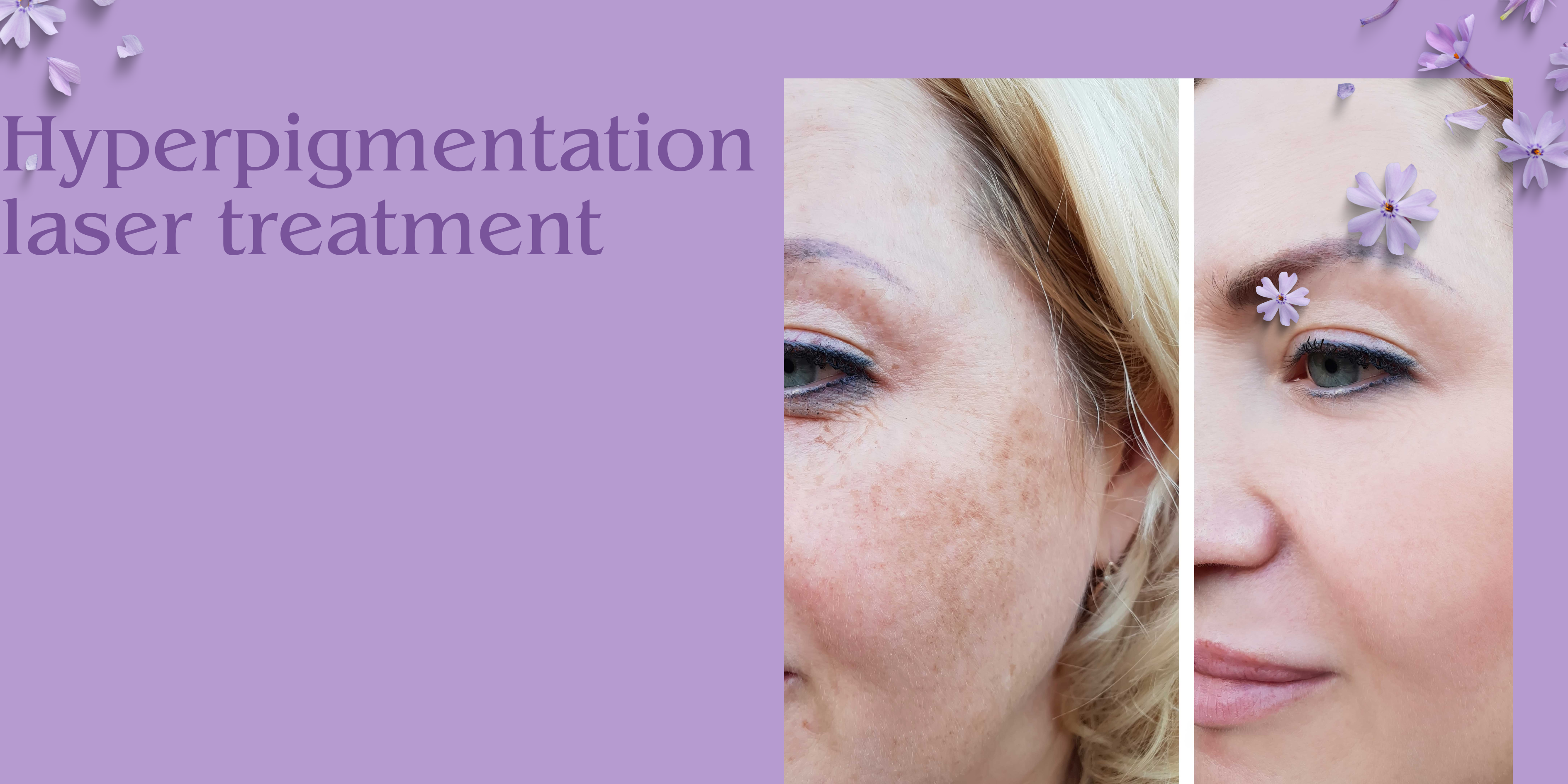 hyperpigmentation laser treatment